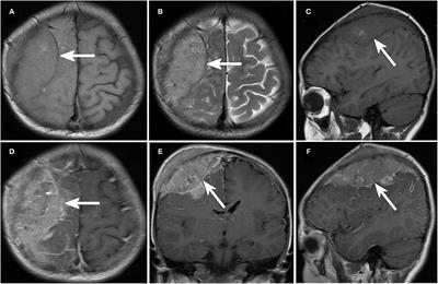 Intracranial Metastases Tend to Be Overt and Predict Poor Prognosis in Children With Neuroblastoma